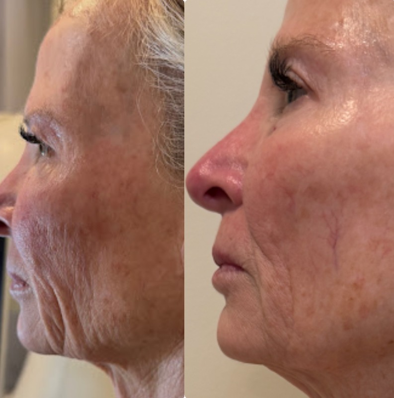 Face & Jawline T-Shape Facial results — Before and after T-Shape 2 facial treatment