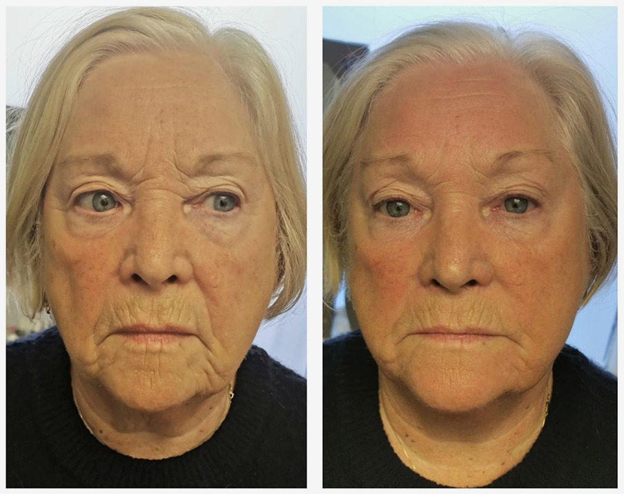 Full Face T-Shape Facial results — Before and after T-Shape 2 facial treatment