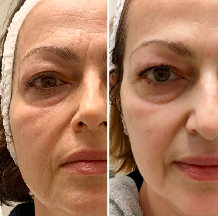 Eye & Cheek Area T-Shape Facial results — Before and after facial treatment