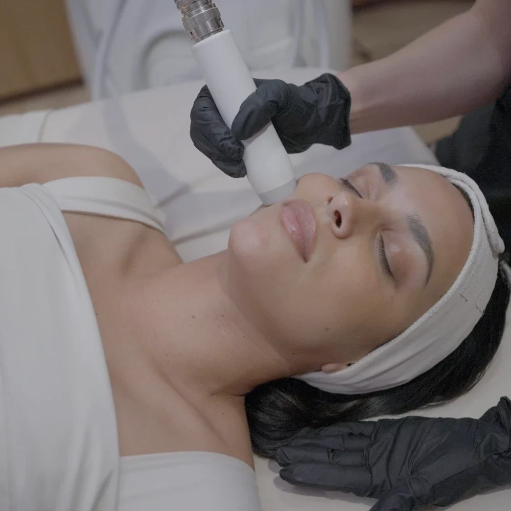 T-Shape 2 facial treatment on the cheek at iCRYO Daniel Island
