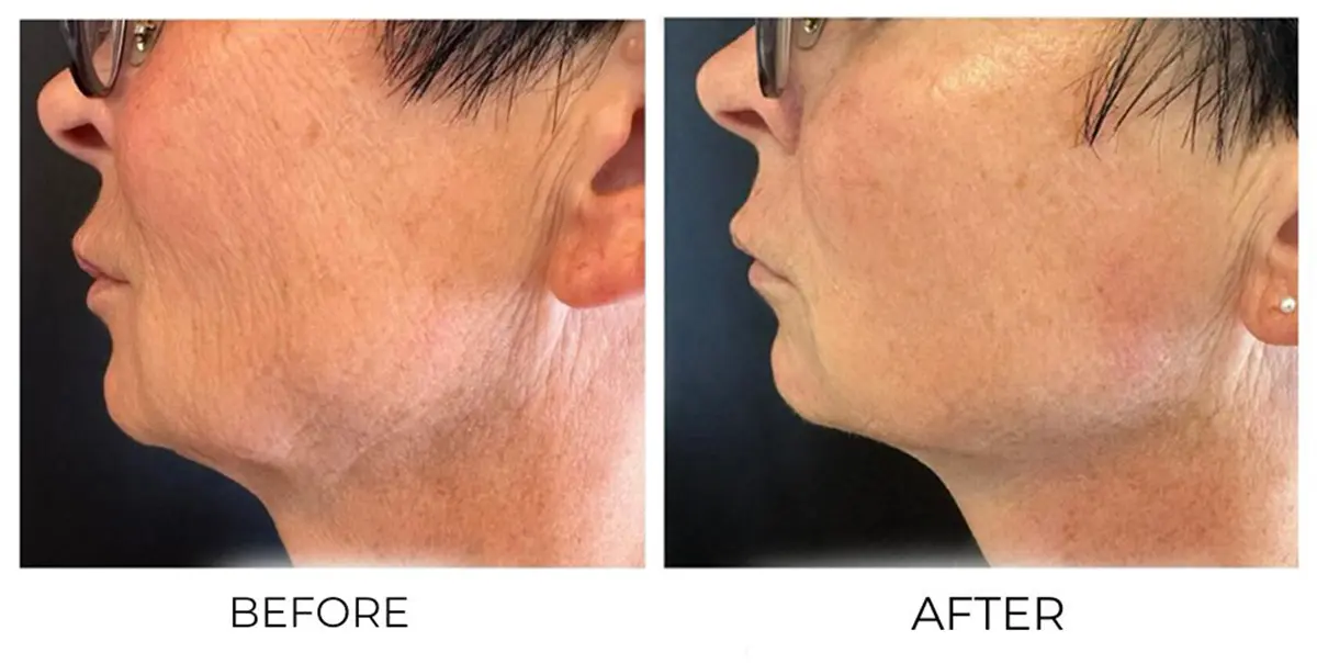 Face & Neck T-Shape Facial results — Before and after T-Shape 2 treatment series