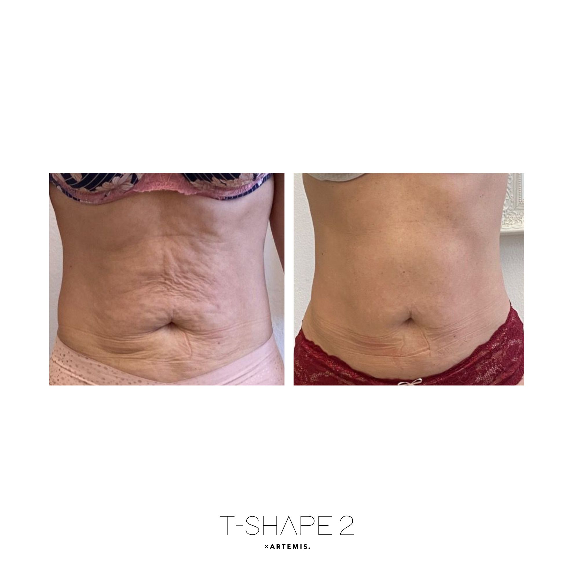 Abs T-Shape 2 results — After treatment series